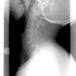 cervicale